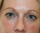 Feel Beautiful - Filler beneath lower eyelids - After Photo